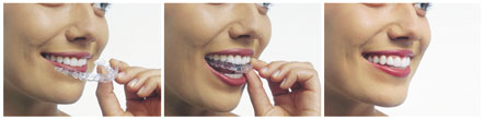 Invisalign